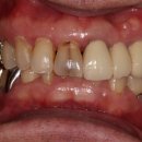 퍼스트민치과의원 | 용현동 인하대역치과) 앞니 색상, 모양 치료 후기 올려요