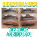 영라인의원 | 아이라인문신제거_4차] 반영구아이라인문신제거 4차 내돈내산후기 숙원사업 (대구피부과후기) 아프지만...