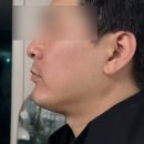 홍대 피부과 남자 이중턱 관리 인모드 후기 [로바에의원]