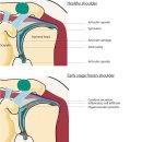 Re: 오십견, 어깨가 굳어지는 이유는? 이미지