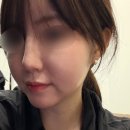 달코 | 코조각주사 한달 후기 콧대주사 콧볼주사 후기 안양역피부과 안양성형외과