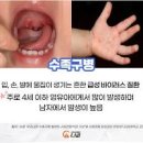 엔테로바이러스 장바이러스고열 발진 구내염 장염 폐렴 수족구병 이미지