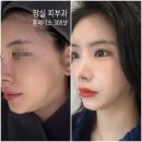 보광(아) | 잠실 피부과 튠페이스 주기 및 3주 얼굴형변화 후기 강력추천