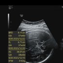 덕이의바늘이야기 | [조기진통] 임신 33주 5일 조기진통 4박 5일 입원 후기