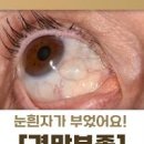 눈 흰자 부음 눈 흰자 노란색 눈 흰자 물집 정리 이미지