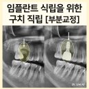 부분교정을 이용한 임플란트 전 구치 직립