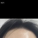 드림페이스의원 | 20대 보톡스 내돈내산 저렴한 효과좋은 시술 후기 (주름보톡스 이마보톡스 국내산, 제오민, 침샘보톡스)