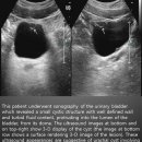Urachal cyst in urinary bladder 이미지
