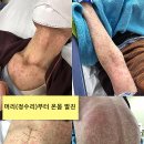 (스티바가 4알 -13일째) 온몸 발진 이미지