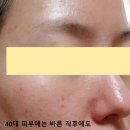 이즈앤트리 어니언 앰플 파헤치기: 흔적 케어부터...정보, 5병째 사용 중인 사람이 들려주는 솔직 후기)