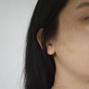 베드로약국 | 편평사마귀 쥐젓 점 천원 몸점 제거 라르떼의원 화곡점 일주일,한달후기
