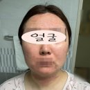 리바운드 | 탈스테로이드 리바운드 과정 후기 (2) : 한약을 먹기 시작하다