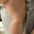 [병원/대전]토리소아청소년과의원 피부 후기