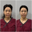 부산두레학교 (특수학교) | 부산 한의원 두상교정 안면비대칭 후기 | 교정패키지 2회차 솔직 후기, 조금씩 느끼는 변화