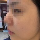 부산 해운대피부관리 모공탄력케어 스킨부스터 모공컨택터 후기