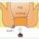 🍁No.496.치질과 한방요법 이미지