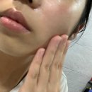 대지약국 | 아젤리아크림 사용법 및 약국 가격 여드름, 흉터 관리 후기