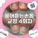 [시흥]물어뜯는손톱 교정 4회차 받은 후기/시그네일 물어뜯는손톱 교정 전문