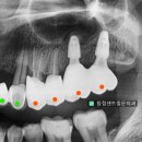 탕정센트럴문치과의원 네이버블로그