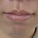 31140-9-21-14 | [전주레이저제모]전북 전주 남자 턱 수염 인중 레이저제모 21회차 후기(내돈내산)