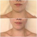 NANA 코스메틱 | 해운대에스테틱 추천 끌리메 센텀점 끌링 작은얼굴 내돈내산 후기