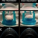 &#34;라식수술 필요 없다&#34;…1분 만에 시력 교정하는 기술 나왔다 이미지