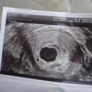 아주다남병원 | 첫 임신, 유산 이야기 : 난황 없음 / 고사난자 판정