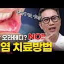 입안 염증 물집 수포 구내염 입안 헐었을 때 원인 증상 치료 혓바늘 알보칠 이미지