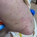 최봉석 | 아토피아기 알레르기검사 / 칠곡경북대병원 알레르기내과 최봉석 교수님 / 알레르기검사후기