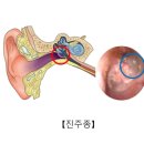 에이스보청기 이미지