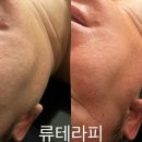 더건강여기테라피