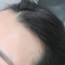 헤어라인 이미지