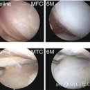 무릎 퇴행성 관절염에도 효과 있어 이미지