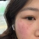 쏘인뷰티 | 강남 잠실 기미제거•잡티제거 / 강남 제로스팟 솔직 후기 [미작뷰티 강남본점]