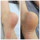 김해패디플래닝 미쁘나다뷰티 발각질제거 후기