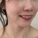 강남역치과 제로네이트 최종 부착 후기 (무삭제라미네이트 앞니, 가격, 부작용)