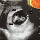 은평구 보건소 화장실 | 동결3차⑥::6주4일 심장소리, 초음파, 보건소 임산부등록(은평구보건소), 마티네차움 산후조리원 예약