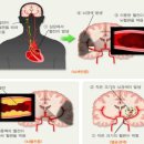 I63 뇌경색증(Cerebral infarction)과 ﻿G46.7*기타 열공증후군(I60-I67†)의 비교 이미지