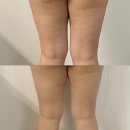 동남로18길 | 송파 바디관리 추천, 디어림 송파가락점 하체 슬리밍 후기 (셀룰라이트 변화 사진 포함)