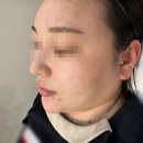 대구 범어동 광채필 여드름 붉은자국(여드름필링)