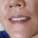 서정희피부미소 | 서정희 팔자주름패치 퍼레스패치 사용후기
