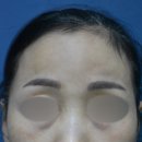 이마로 | 대구 이마필러 후기, 울퉁불퉁한 이마로 고민했던 환자