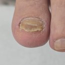 (주)레오솔루션 | 문제성 발톱 저자극 제거 관리 50대 고객님 후기