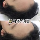 217-운정3-217 | 파주운정 헤어라인 해결해주는 이결