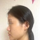 매교하늘이비인후과의원 | 압구정역 코성형 어디에서 해야 하나? 코 수술 한 달 후기