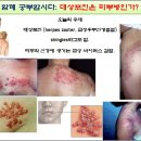 대상포진 정의, 증상,원인, 치료 이미지