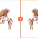 고관절 통증 있을때 원인 이미지
