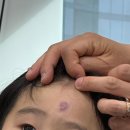 더리버피부과의원 | 대전 화염상모반 치료 아이엠피부과 후기