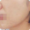 민트성형외과의원 | 민트실리프팅 부작용 후기