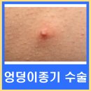 덩어리 | 엉덩이 종기 염증 덩어리 제거 수술 후기